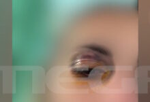 Άγριος-ξυλοδαρμός-25χρονης-από-τον-σύντροφό-της:-Την-τράβηξε-από-τα-μαλλιά-και-της-μαύρισε-το-μάτι-–-«Δεν-με-άφηνε-να-φύγω»