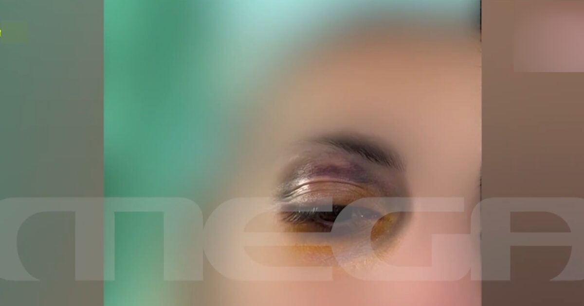 Άγριος-ξυλοδαρμός-25χρονης-από-τον-σύντροφό-της:-Την-τράβηξε-από-τα-μαλλιά-και-της-μαύρισε-το-μάτι-–-«Δεν-με-άφηνε-να-φύγω»