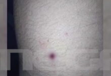 Αίγιο:-Νέες-φωτογραφίες-με-τα-τραύματα-των-παιδιών-–-«Ο-46χρονος-έκρυψε-την-καραμπίνα-και-πήγε-για-ύπνο»