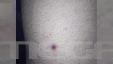 Αίγιο:-Νέες-φωτογραφίες-με-τα-τραύματα-των-παιδιών-–-«Ο-46χρονος-έκρυψε-την-καραμπίνα-και-πήγε-για-ύπνο»