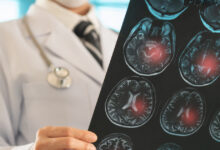 Φάρμακο-βοηθά-στην-μείωση-των-επαναλαμβανόμενων-εγκεφαλικών-επεισοδίων-–-Ο-ρόλος-της-Ελλάδας-στη-μελέτη