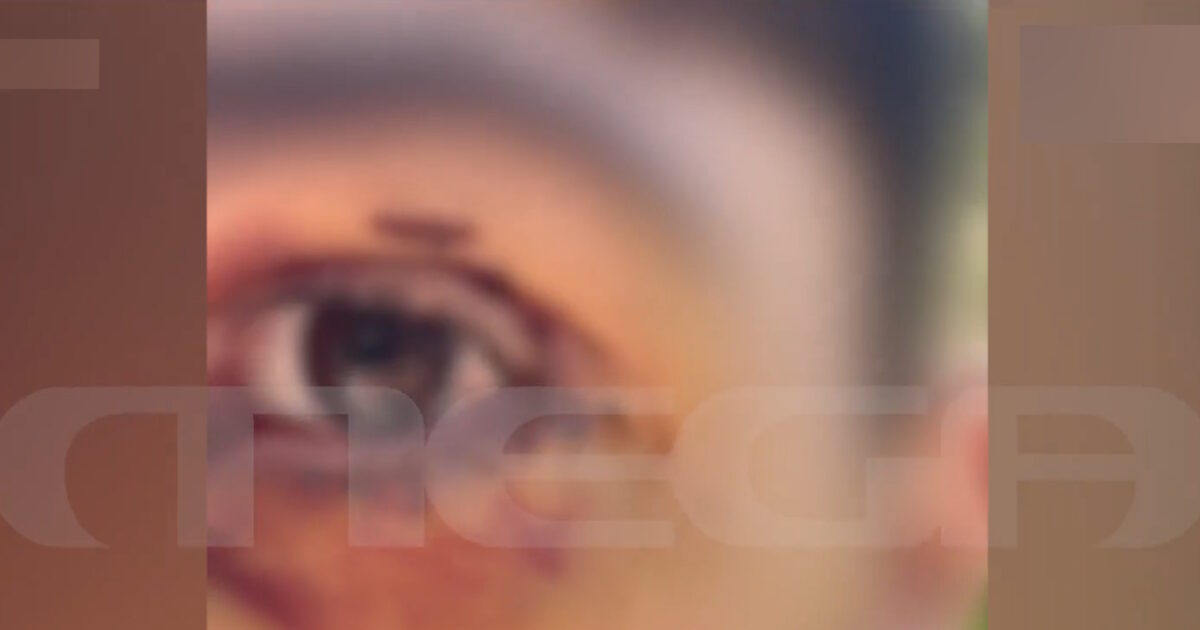 Ιωάννινα:-Άγριος-ξυλοδαρμός-16χρονου-από-ανήλικους-–-«Πήγε-βόλτα-και-κινδύνευσε-να-χάσει-την-όρασή-του»-λέει-η-μητέρα-του