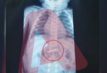 Στο-νοσοκομείο-3χρονο-αγόρι-που-κατάπιε-ξυραφάκι:-Υποβλήθηκε-σε-χειρουργική-επέμβαση-και-αναρρώνει