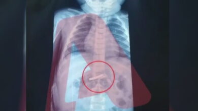 Στο-νοσοκομείο-3χρονο-αγόρι-που-κατάπιε-ξυραφάκι:-Υποβλήθηκε-σε-χειρουργική-επέμβαση-και-αναρρώνει