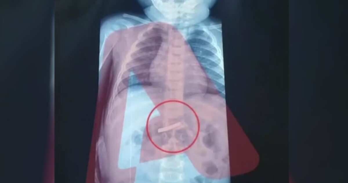 Στο-νοσοκομείο-3χρονο-αγόρι-που-κατάπιε-ξυραφάκι